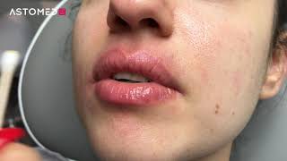 Ferulac Dubai Lips Peel  ASTOMED klinikutrustning [upl. by Occer30]