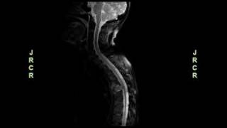 Radiology video Aggressive Adenoid Cystic Carcinoma With Asymptomatic Spinal Cord Compression [upl. by Ladnek]