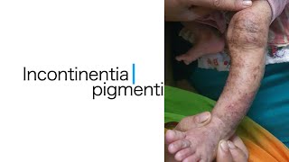 Incontinenta Pigmenti [upl. by Lonni]