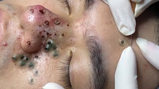 Big Cystic Acne Blackheads Extraction Blackheads amp Milia Whiteheads Removal Pimple Popping 0034💆 [upl. by Uta]