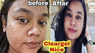 Acne के लिए Best Medicine  Cleargel nico  I used clindamycin and nicotinamide for my hormonal Acne [upl. by Ahsimat565]