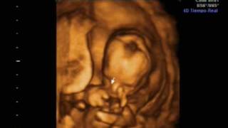 Ecografia 16 semanas 4D y 2D Ultrasound Irati [upl. by Hermosa]