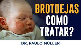 Brotoejas Como Tratar – Dr Paulo Müller Dermatologista [upl. by Iat]