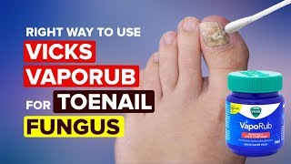 The Right Way To Use Vicks Vaporub for Toenail Fungus  Toenail Fungus Cure [upl. by Yetta]