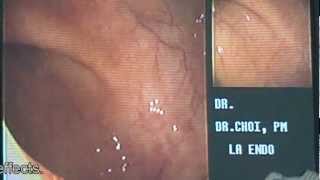 1 Minute Colonoscopy  Los Angeles Colonscopy [upl. by Elleahcim]