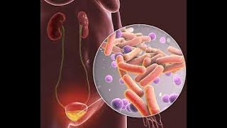 Infección de Vías Urinarias Explicación Cistitis Pielonefritis [upl. by Adnertal]