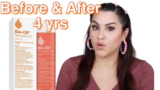 Bio Oil Before amp After 4 Years Later [upl. by Annaeel]