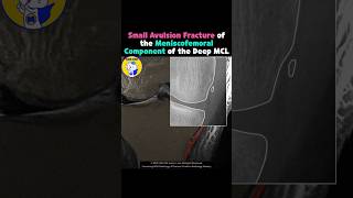 Fig 3A22 Avulsion fracture of meniscofemoral ligament [upl. by Essilrahc651]