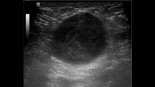 What is GALACTOCELE Blocked Milk Ducts [upl. by Kraft986]