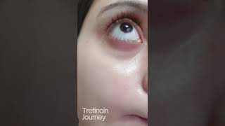 Tretinoin Journey  Day 01  Skin Care  Skin A skincare retinol tretinoin skincareroutine [upl. by Anirtruc]