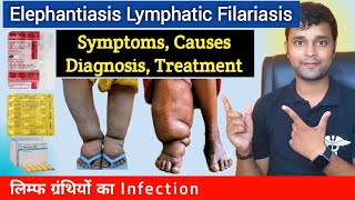 Elephantiasis  Filariasis  Symptoms Causes Diagnosis Treatment Prevention In Hindi [upl. by Inaniel]