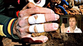 Climbing Related Finger Injuries Treatment [upl. by Benioff]