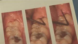 How To Alleviate Infected Wisdom Tooth [upl. by Iat]