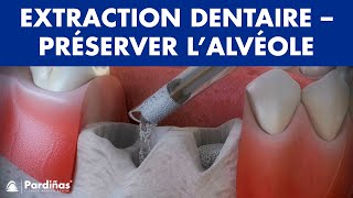 Extraction dentaire – Traitement pour préserver l’alvéole © [upl. by Angeli551]