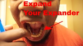 How To TURN Braces Expander [upl. by Ytirehc]