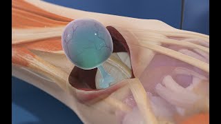 Ganglion Cyst Removal 3D Animation [upl. by Walters]