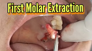 First molar extraction 26 [upl. by Roderica]