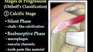 Calcific Tendonitis  Everything You Need To Know  Dr Nabil Ebraheim [upl. by Akcirderf]