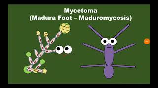 7 Mycetoma الورم الفطري [upl. by Court]