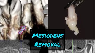 Palatal Mesiodens Removal [upl. by Sualakcin]