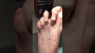 Pre dislocation second toe syndrome with plantar stump neuroma formation [upl. by Fischer904]