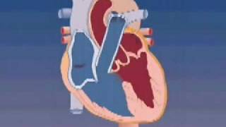 Tetralogy of Fallot [upl. by Lindley]