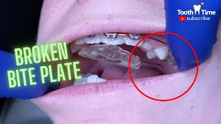 Braces On 10 years old patient  Broken Bite Plate  Tooth Time Family Dentistry New Braunfels [upl. by Halet493]