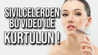 SİVİLCELERDEN KURTULUN  Sivilceye Ne İyi Gelir ve Nasıl Geçer Yüzdeki Sivilce İzleri Nasıl Geçer [upl. by Lizzy944]