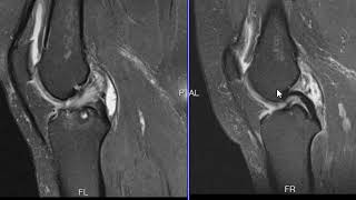 Mucoid degeneration of the ACL [upl. by Nema]