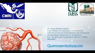 112 Actualidades en Quimioembolización de tumores hepáticos  Dr Arellano [upl. by Oalsecnew63]