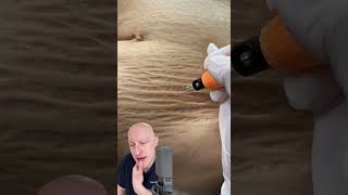 Plasma Pen As A Cure For Stretchmarks  Doctor Reacts [upl. by Gerladina937]