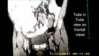 Intussusception on CT Scan Practical Review Target Sign [upl. by Dlorej785]