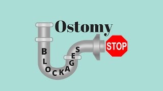 Dealing With Ostomy Blockages Ostomy Tips [upl. by Parhe]