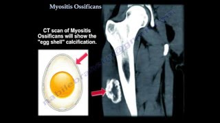 Myositis Ossificans  Everything You Need To Know  Dr Nabil Ebraheim [upl. by Jeggar]