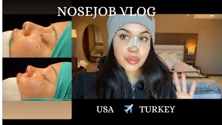 I FLEW TO TURKEY ALONE FOR A NOSEJOB Rhinoplasty results recovery amp 2 year update [upl. by Gamal]