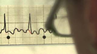 EKG für Pflege Teil 20  Vorhofflattern interpretieren [upl. by Yhotmit]