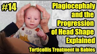 14 Plagiocephaly and the Progression of Head Shape Explained Torticollis Treatment in Babies [upl. by Liuqnoj963]