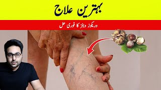 Dr ZeeThis is the best Remedy for Varicose Veins  डॉक्टर ज़ी [upl. by Hayes]