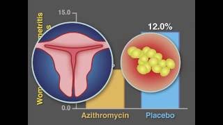 PostCesarean Infection and Antibiotic Prophylaxis  NEJM [upl. by Frantz13]