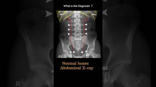 Normal bones  Abdominal Xray 10 Abdominal Xray  System and anatomy radiologychannel007 [upl. by Oruasi]