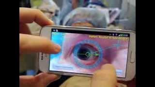 TOREASY  first noncontact Smartphone enabled eye marking for toric IOLs [upl. by Menashem854]