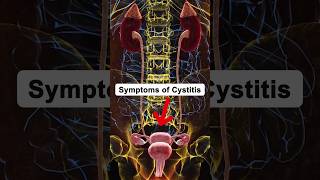 Symptoms of Cystitis cystitis health healthtips shorts [upl. by Uokes]