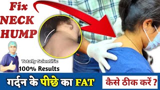 Neck Hump Exercises in Hindi  How to remove fatty Neck Hump  Dowagers hump Buffalo hump Exercise [upl. by Neirbo315]