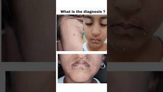 Diagnosis and treatment of Molluscum Contagiosum [upl. by Althee259]