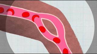 Sickle Cell Anaemia Explained [upl. by Adriel202]