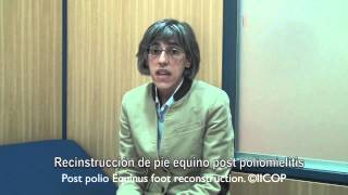 🎓SECUELA de POLIO  CORRECCION DE pie EQUINO por polio [upl. by Ymereg]