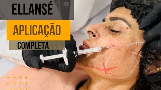 Aplicação Completa de Ellansé com Resultado Volume e Bioestimulo na Harmonização Facial [upl. by Zeeba]