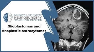 Glioblastomas and Anaplastic Astrocytomas [upl. by Slifka907]