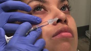 Belotero Injections to Correct the Tear Trough Hollow [upl. by Strephonn]