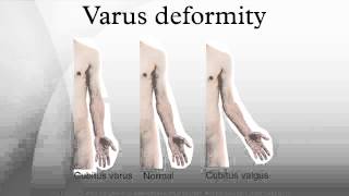 Varus deformity [upl. by Duile]